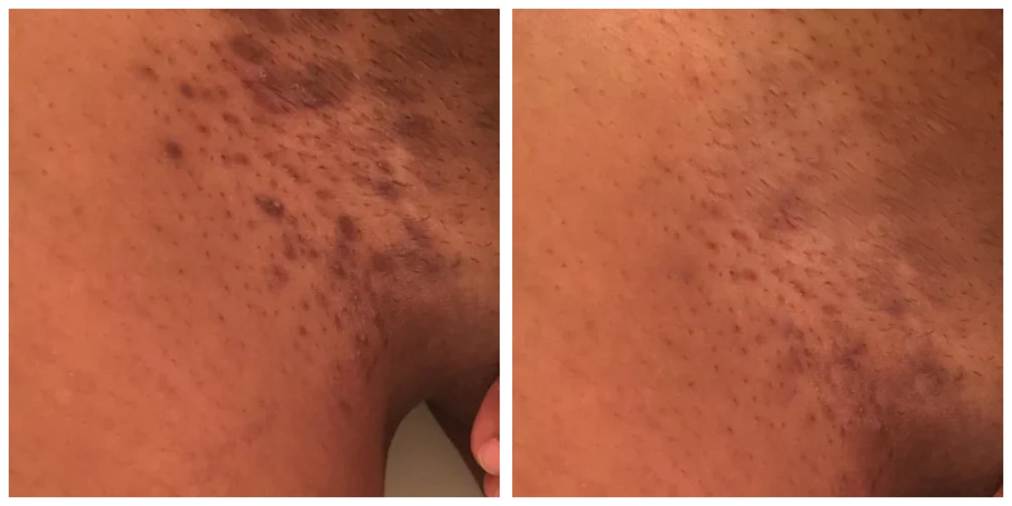 Dark Marks Eraser Kit