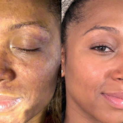 Dark Marks Eraser Kit