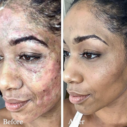 Dark Marks Eraser Kit