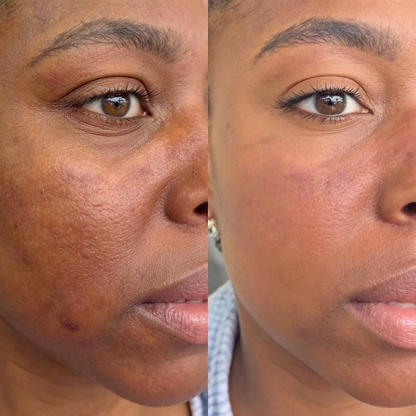 Dark Marks Eraser Kit