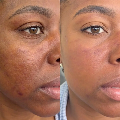 Dark Marks Eraser Kit